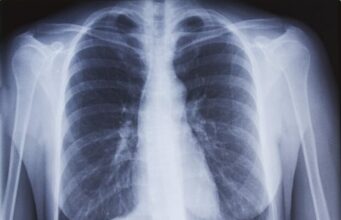 Radiographie