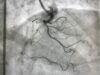 Fibroscopie bronchique