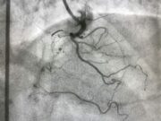 Fibroscopie bronchique