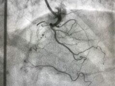 Fibroscopie bronchique