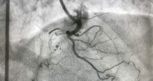 Fibroscopie bronchique