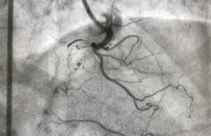 Fibroscopie bronchique