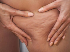 Cellulite : comment la faire disparaître ?