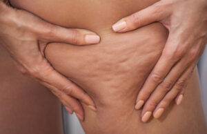 Cellulite : comment la faire disparaître ?