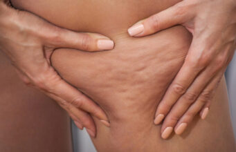 Cellulite : comment la faire disparaître ?
