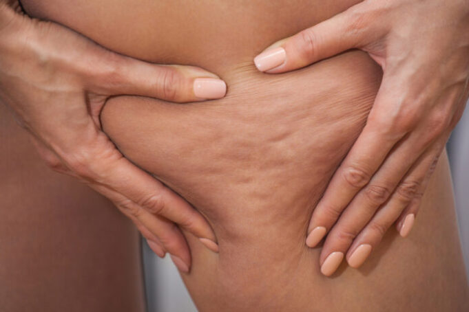 Cellulite : comment la faire disparaître ?