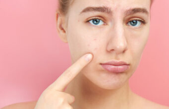 Bien-être : Top 5 des idées reçues sur l’acné