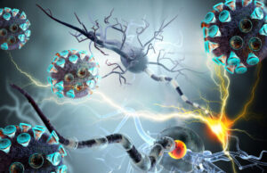 Covid-19 : séquelles neurologiques de type Alzheimer