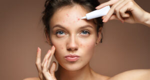 Acné : un traitement 100 % naturel grâce à une algue