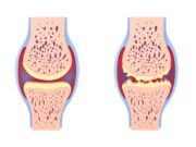 Arthrose et ferritine élevée, quel lien de cause à effets?