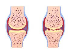 Arthrose et ferritine élevée, quel lien de cause à effets?