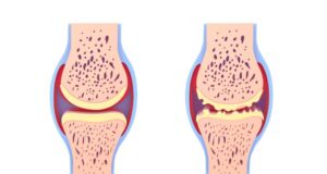Arthrose et ferritine élevée, quel lien de cause à effets?