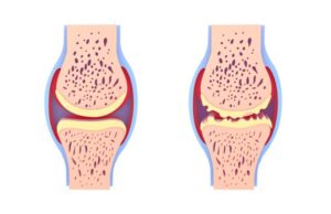 Arthrose et ferritine élevée, quel lien de cause à effets?