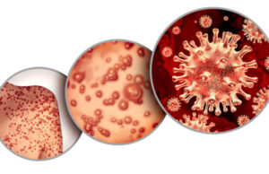 Un cas confirmé en France de variole du singe : pourquoi c’est inquiétant ?