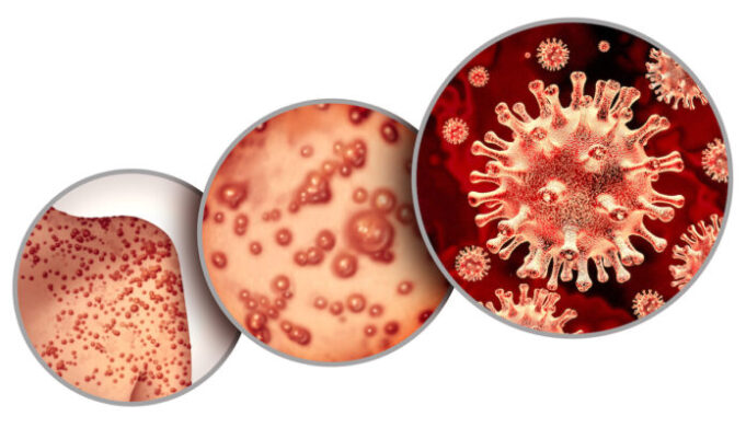 Un cas confirmé en France de variole du singe : pourquoi c’est inquiétant ?