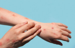 Variole du singe : 16 cas confirmés en France