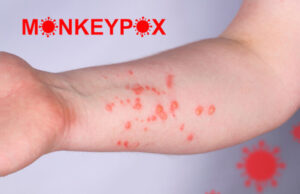 Variole du singe : on connait les symptômes