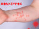 Variole du singe : on connait les symptômes