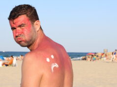 Comment soigner vos coups de soleil ?