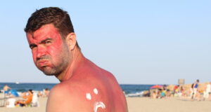 Comment soigner vos coups de soleil ?