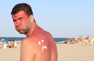 Comment soigner vos coups de soleil ?