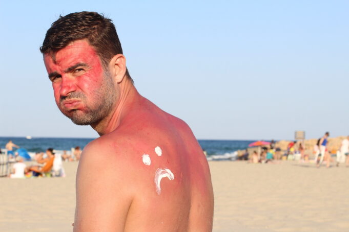 Comment soigner vos coups de soleil ?