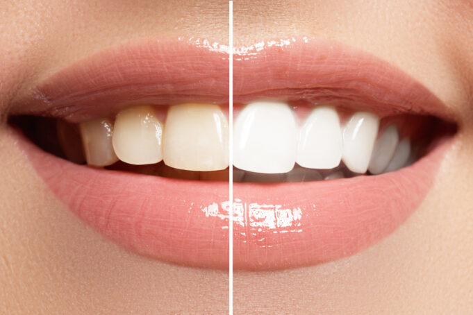 Les aliments à éviter pour garder les dents blanches