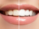 Les aliments à éviter pour garder les dents blanches