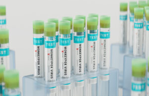 Variole du singe : les tests de détection bientôt remboursés