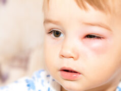Piqûre de guêpe : quand appeler les secours ?