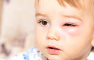 Piqûre de guêpe : quand appeler les secours ?