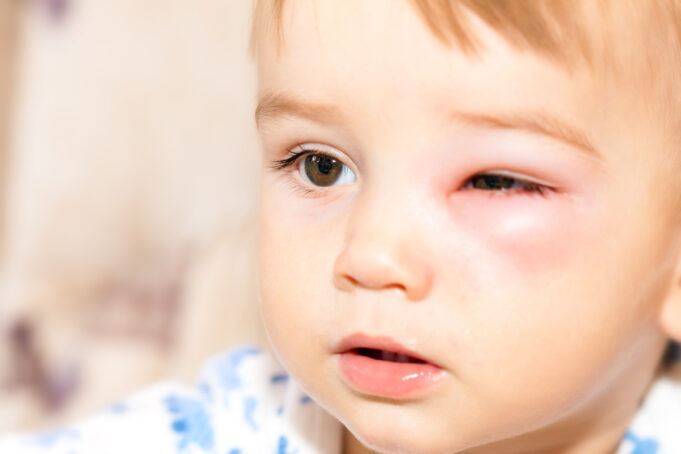 Piqûre de guêpe : quand appeler les secours ?