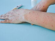 Variole du singe: deux décès en Espagne