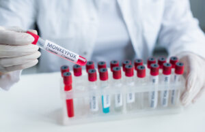 Variole du singe : un nouveau symptôme touche les yeux