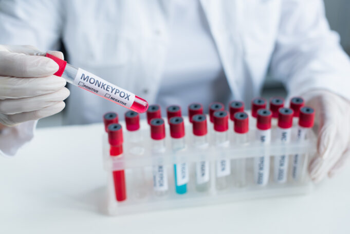 Variole du singe : un nouveau symptôme touche les yeux