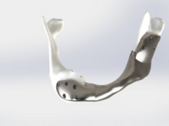 La première mâchoire imprimée en 3D greffée avec succès