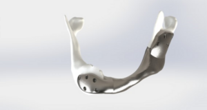 La première mâchoire imprimée en 3D greffée avec succès