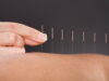 À quoi sert l’acupuncture ?