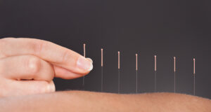À quoi sert l’acupuncture ?