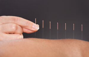 À quoi sert l’acupuncture ?