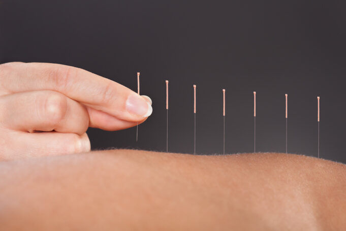 À quoi sert l’acupuncture ?