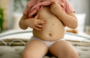 Le vaccin contre la variole du singe n’est pas efficace à 100 %