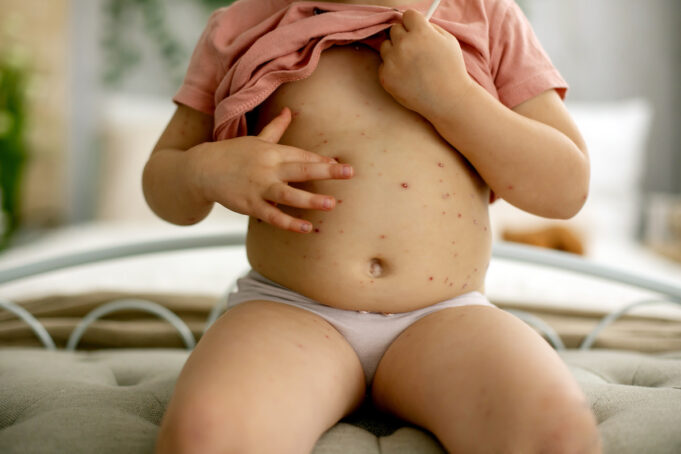 Le vaccin contre la variole du singe n’est pas efficace à 100 %