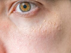 Comment se débarrasser des grains de milium ?
