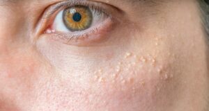 Comment se débarrasser des grains de milium ?