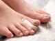 Comment soigner les ongles incarnés ?