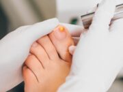 Mycose de l’ongle de pied : diagnostic, symptômes et traitement