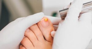 Mycose de l’ongle de pied : diagnostic, symptômes et traitement