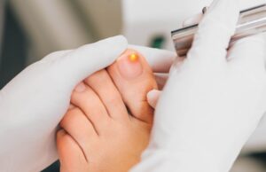 Mycose de l’ongle de pied : diagnostic, symptômes et traitement