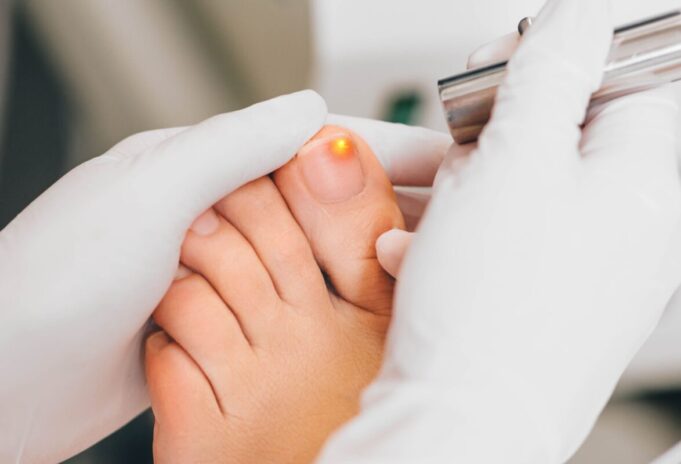 Mycose de l’ongle de pied : diagnostic, symptômes et traitement